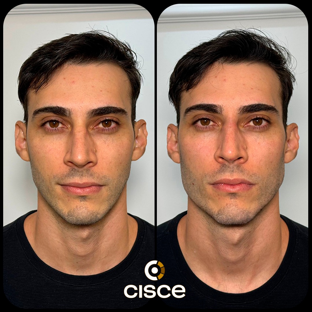 Harmonização Facial